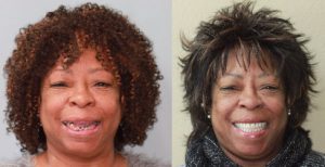 Patient Davetta’s smile before and after dentures