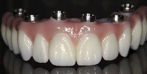 fixed implant bridge