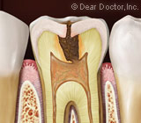 UnderstandingtheSignsandSymptomsofToothDecayandaDiseasedRootCanal