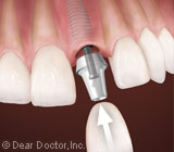 UnderstandingtheProcessofDentalImplants