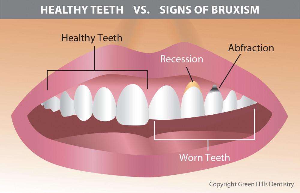 Bruxism Teeth Grinding 0571