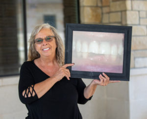 Dental Implants Patient Sandy
